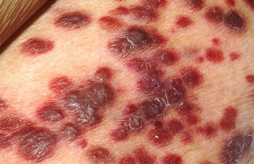 Kaposi's sarcoma on the skin of an AIDS patient
